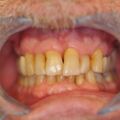 Juni 2014: Klinischer Parodontalbefund im vierteljährlichen Parodontalrecall