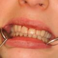 Laborgefertigte Dauerprovisorien Front bei anästhesierten Lippen direkt nach der Eingliederung