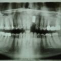 2013 OPG, Sofortimplantation Zahn 21