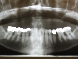 Ausgangssituation nach Entfernung mehrerer zerstörter Zähne und Zahnwurzeln