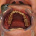 Juni 2014: Klinischer Parodontalbefund im vierteljährlichen Parodontalrecall